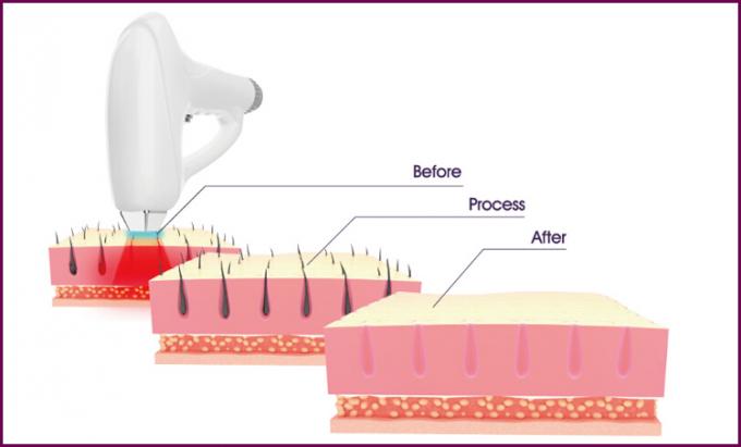 808nm dioda laser menyakitkan klinik mesin hair removal permanen